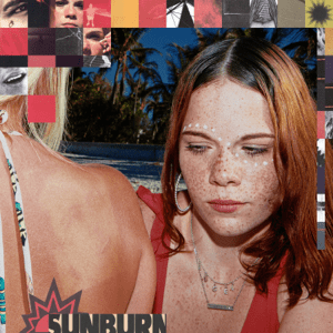 sunburn- dominic fike sunburn- dominic fike